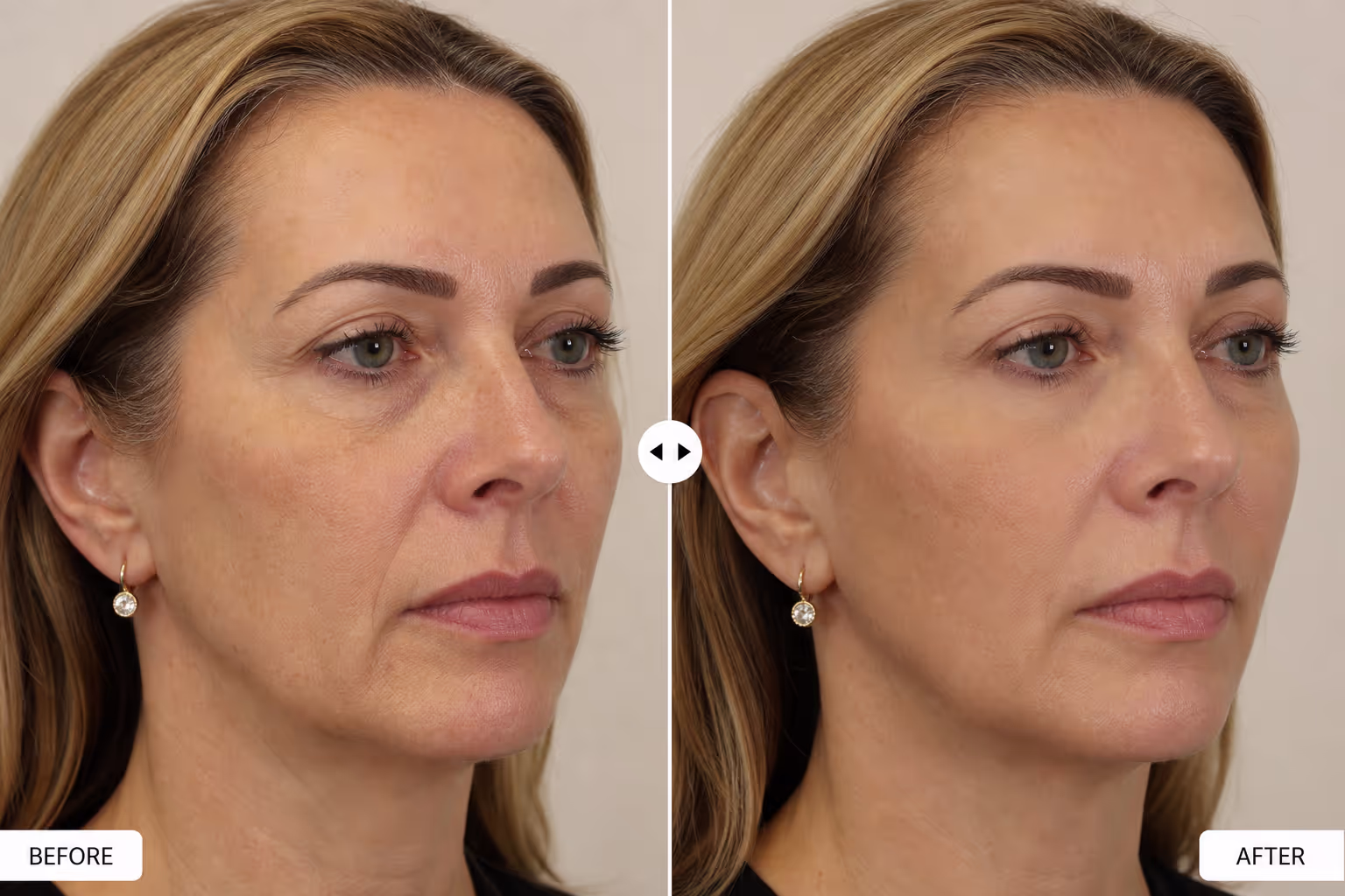 Cosmetic procedure result