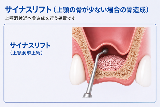 サイナスリフト（上顎洞挙上術）の説明図