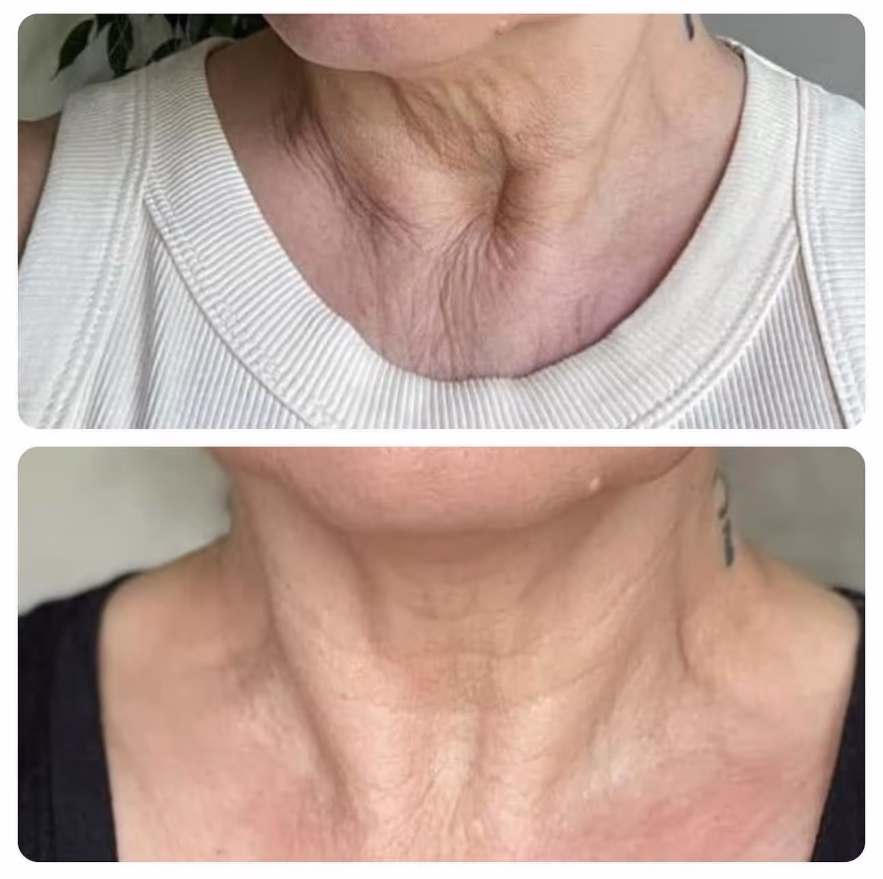Resultados del gel de paprika en el cuello Dos imágenes del cuello de una señora de 60 o 70 años de edad. La de 'antes' tiene muchas arrugas y la de después tiene la piel mucho más firme.