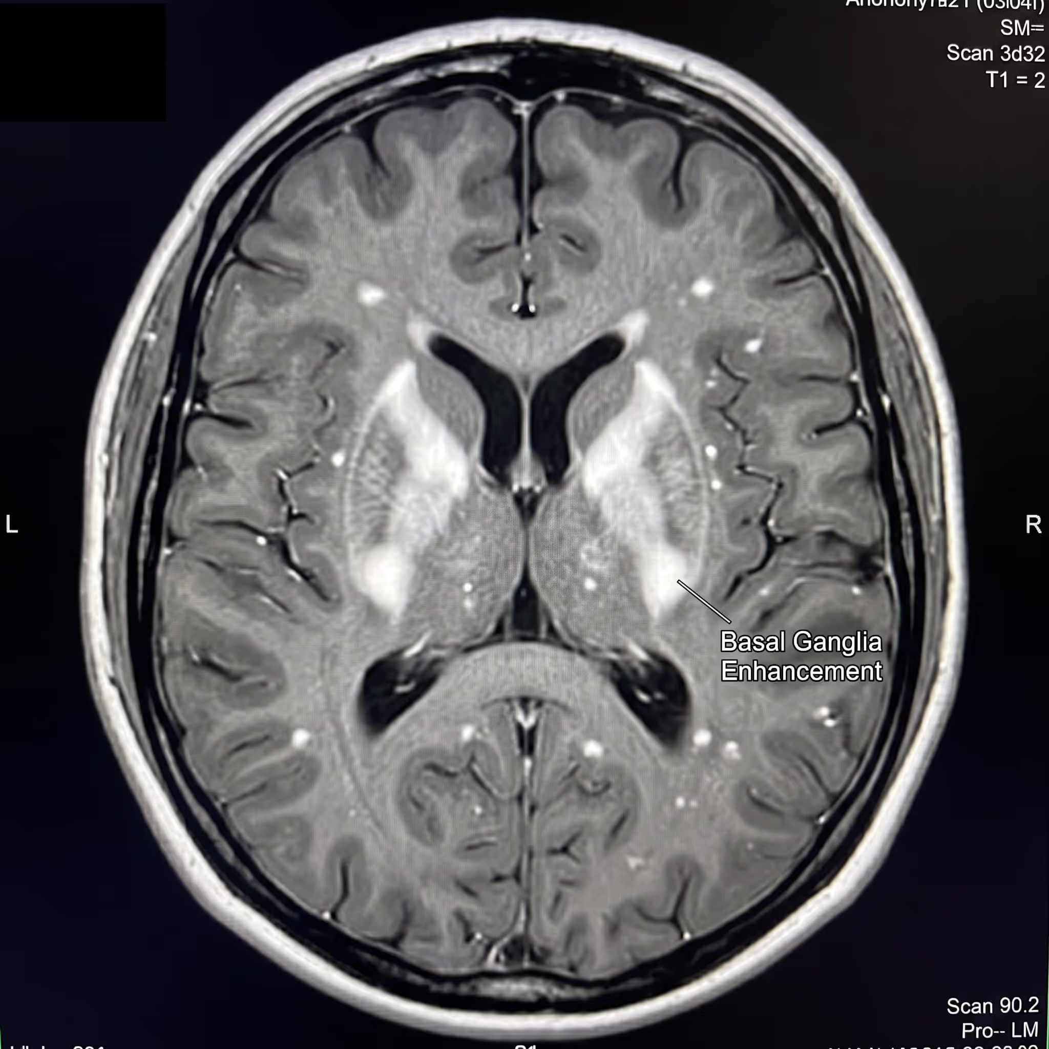 Axial brain MRI showing bilateral bright areas in the basal ganglia, annotated with an arrow and the label 'Basal Ganglia Enhancement,' with L and R orientation markers.
