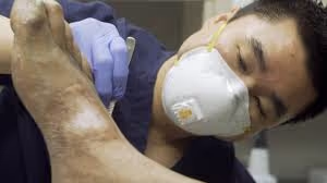 Doctor apply grafting treatment on right foot of the patient